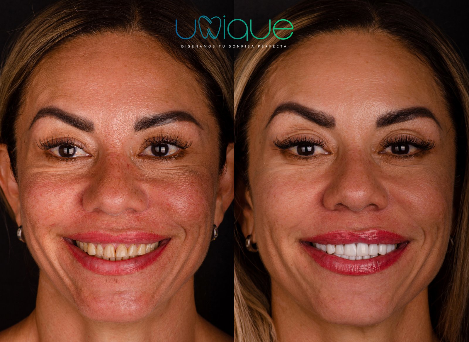 Resultado dental antes y después 1